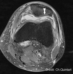 dr quintart Ch IOR-G1:cellules souches mésenchymateuses:rotule: mesenchymal stem cells:patella:postop